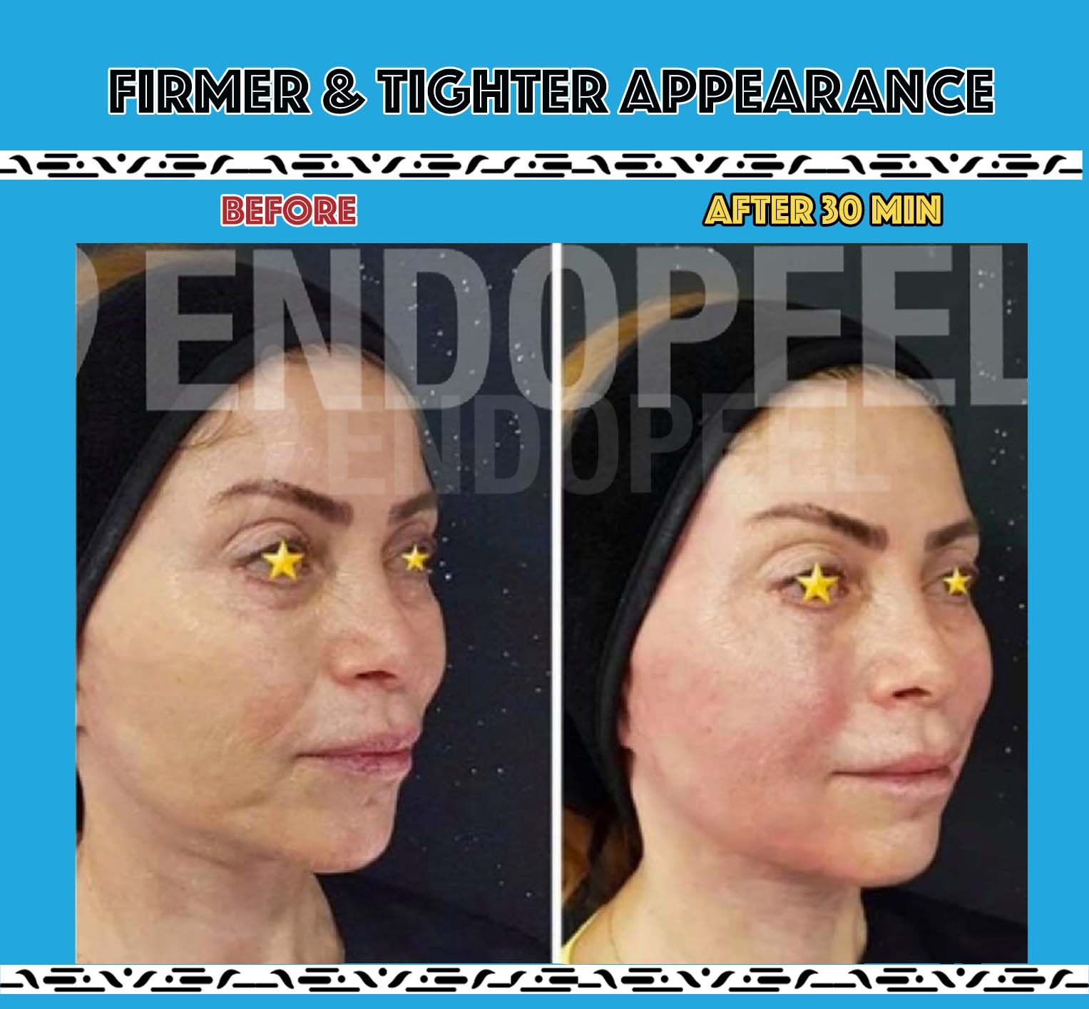 firmer-tighter-face-endopeel