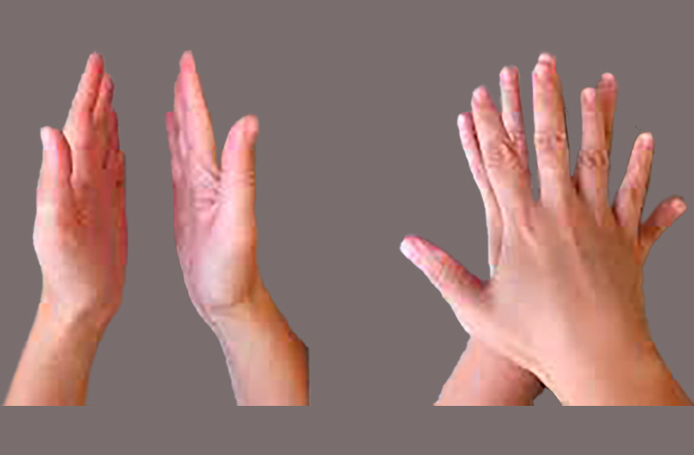 Mirror-image hands illustrating non-superimposable chirality