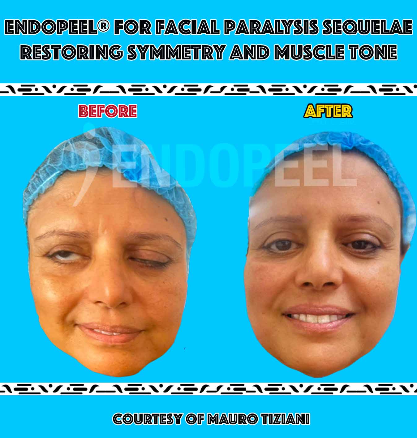 facial-paralysis