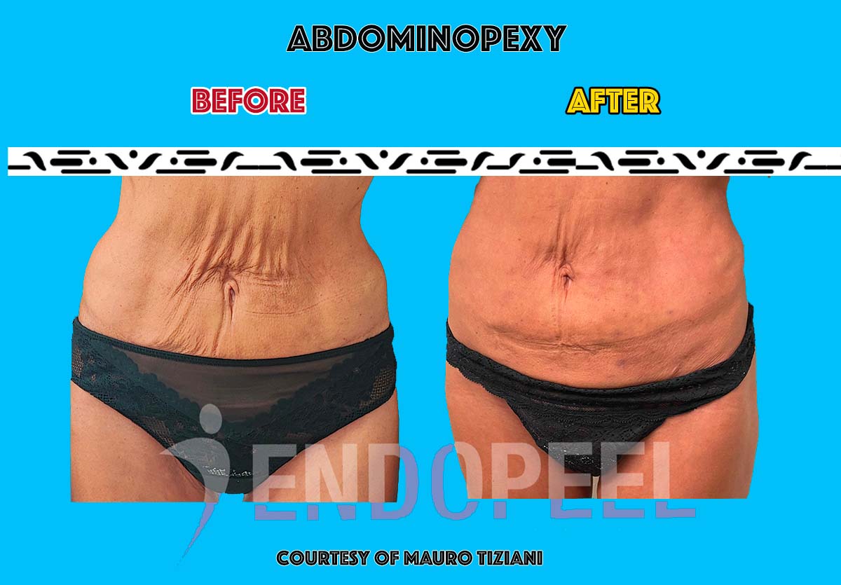 abdominoplasty