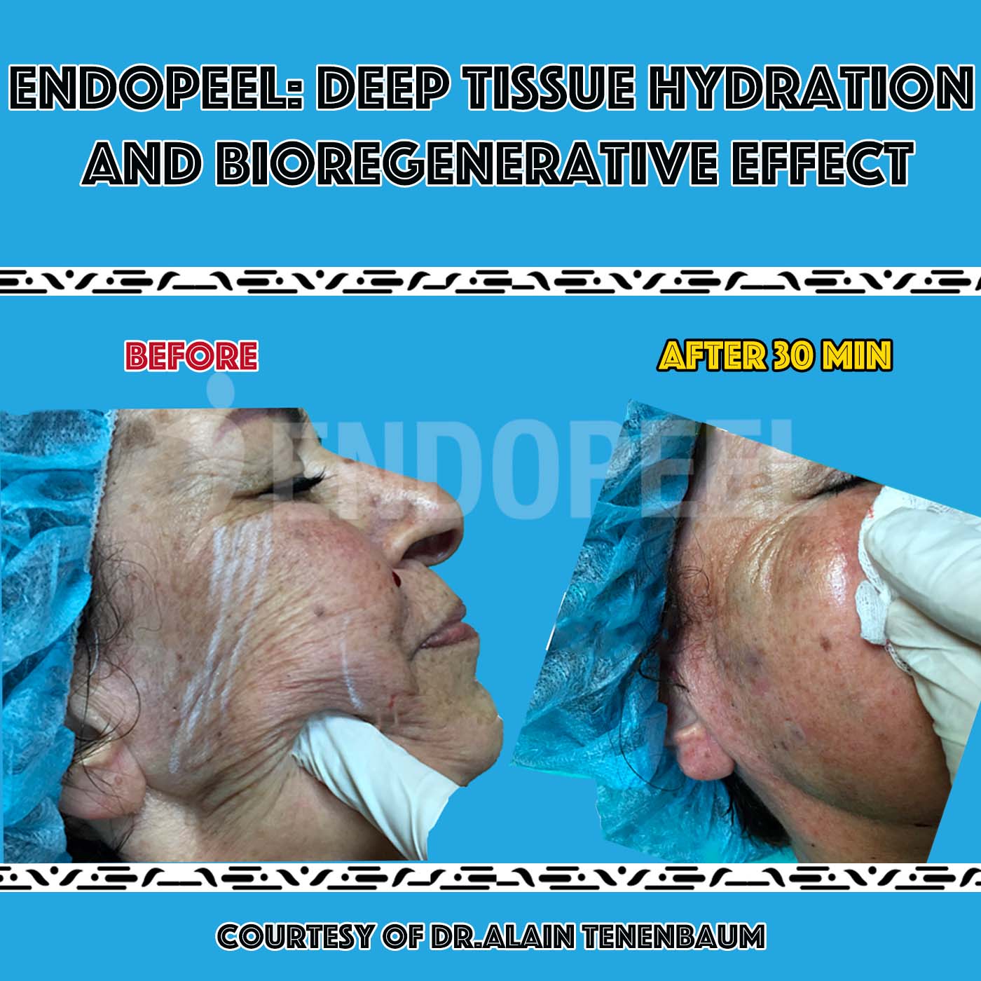 hydration-bioregenerative-endopeel