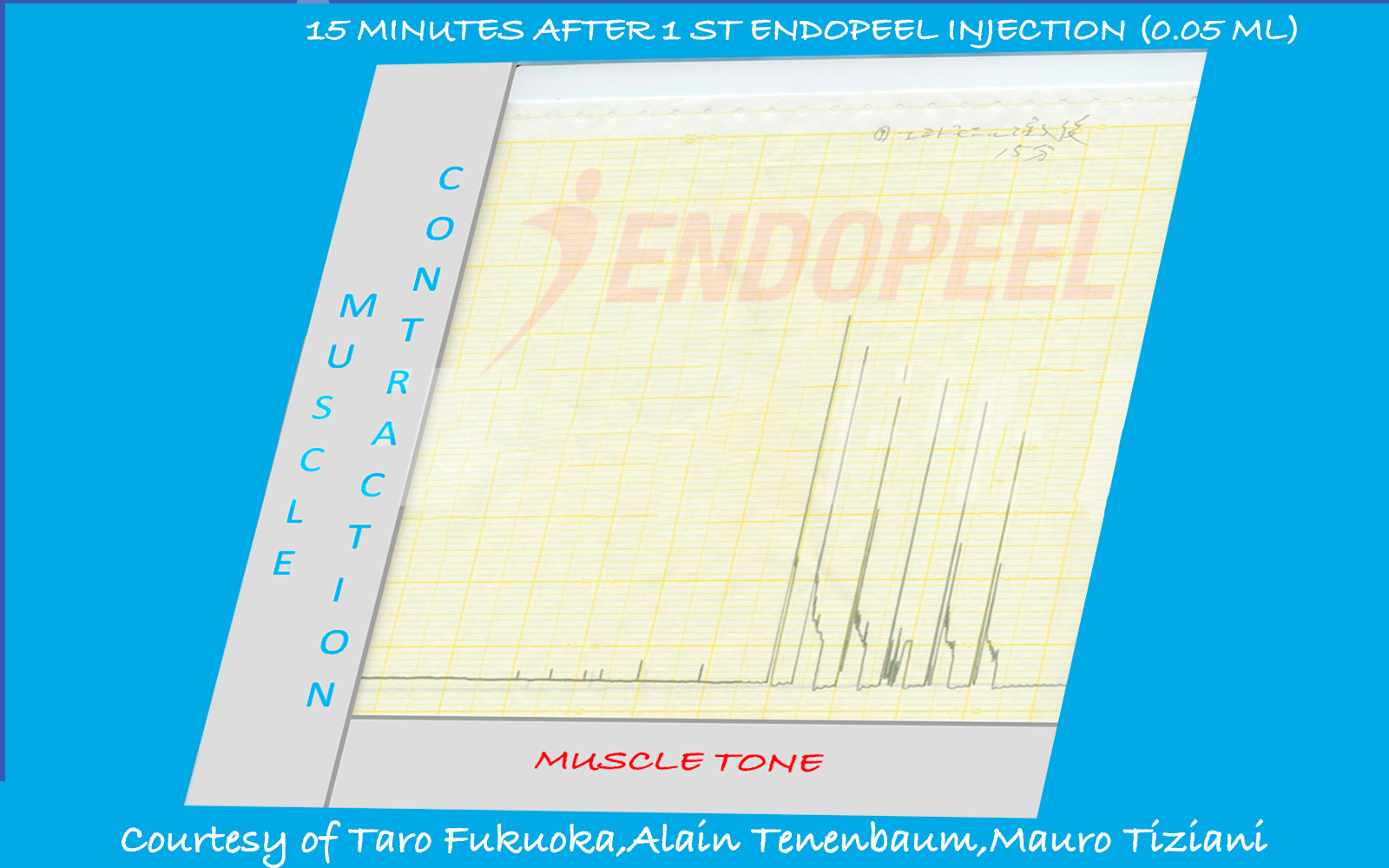 Muscle tracing fifteen minutes after Endopeel® injection demonstrating biomechanical confinement with preserved vitality
