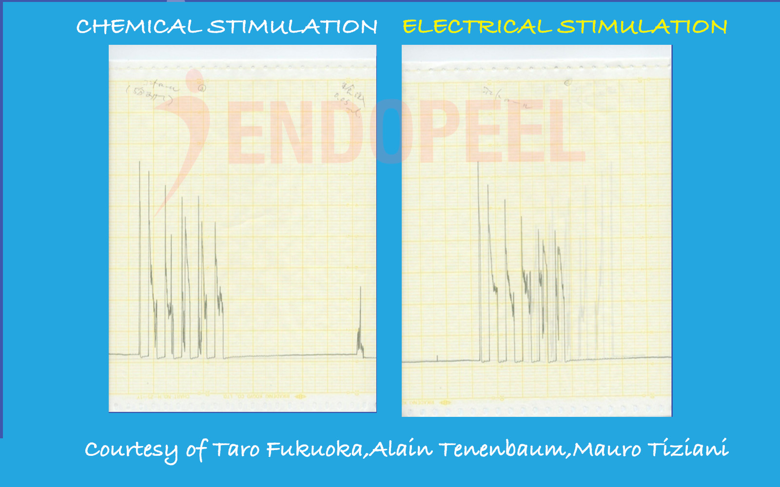 Comparison of electrical stimulation versus chemical stimulation with NaCl 0.9% demonstrating preserved muscle responsiveness prior to Endopeel® injection
