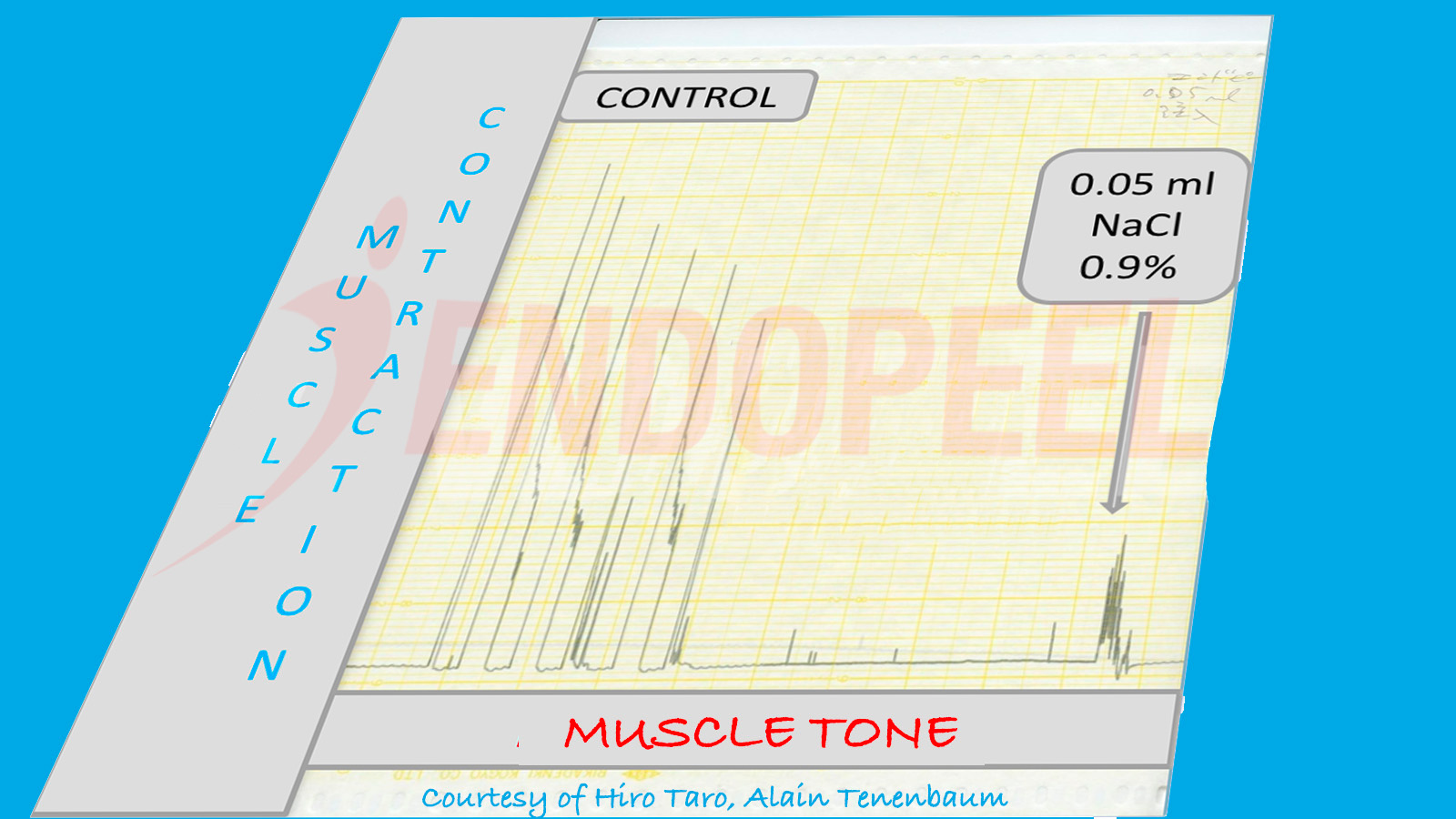 Baseline gastrocnemius tracing illustrating physiologic resting tone (myotension) and normal functional response prior to Endopeel® injection