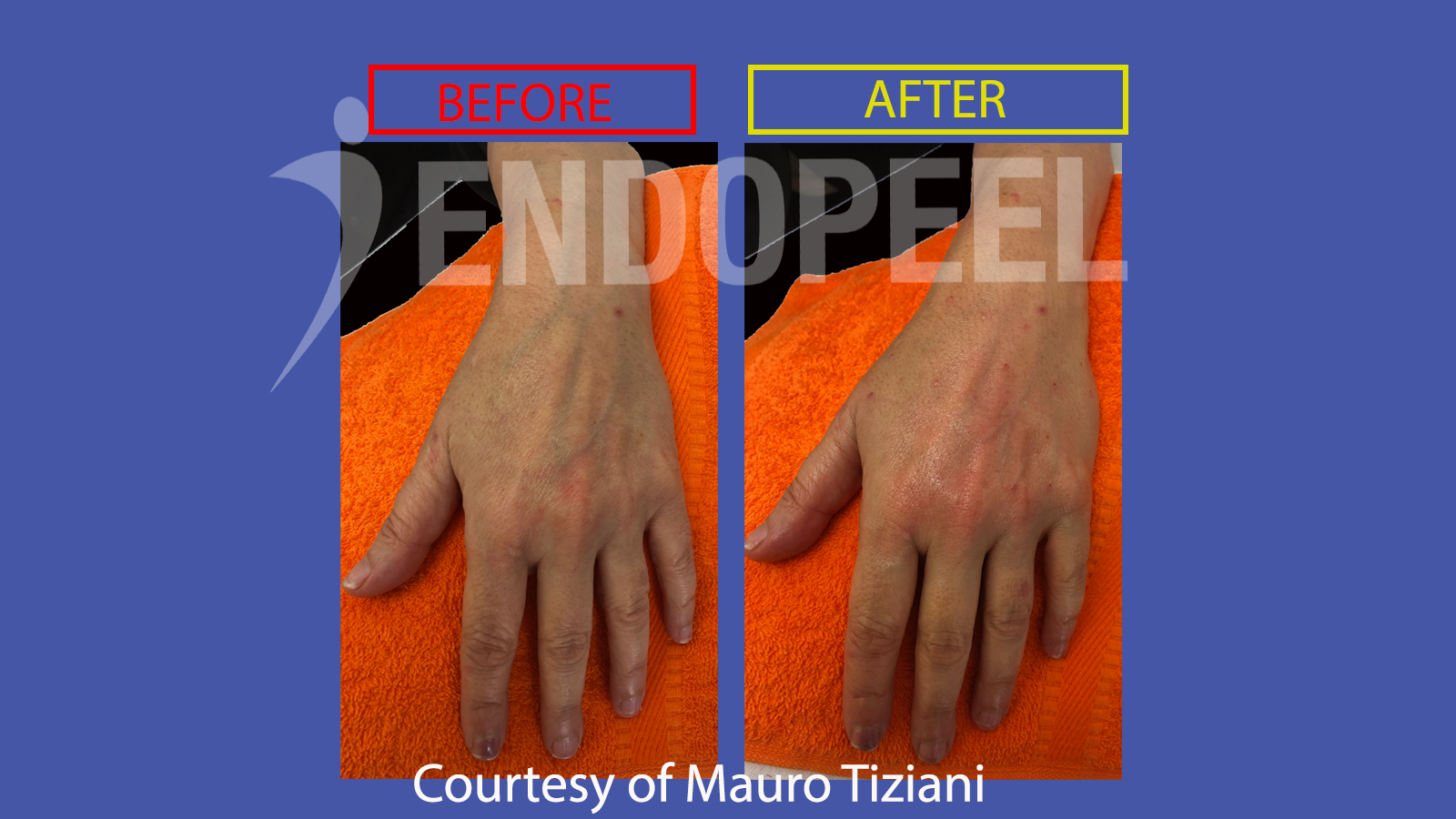 hands endopeel rejuvenation