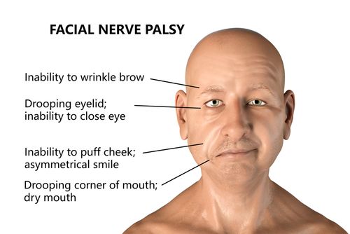 facial palsy