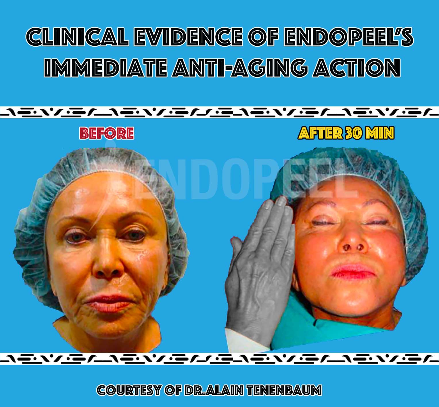 antiaging-indication-endopeel