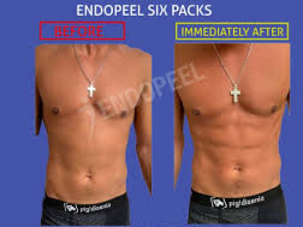 body endopeel