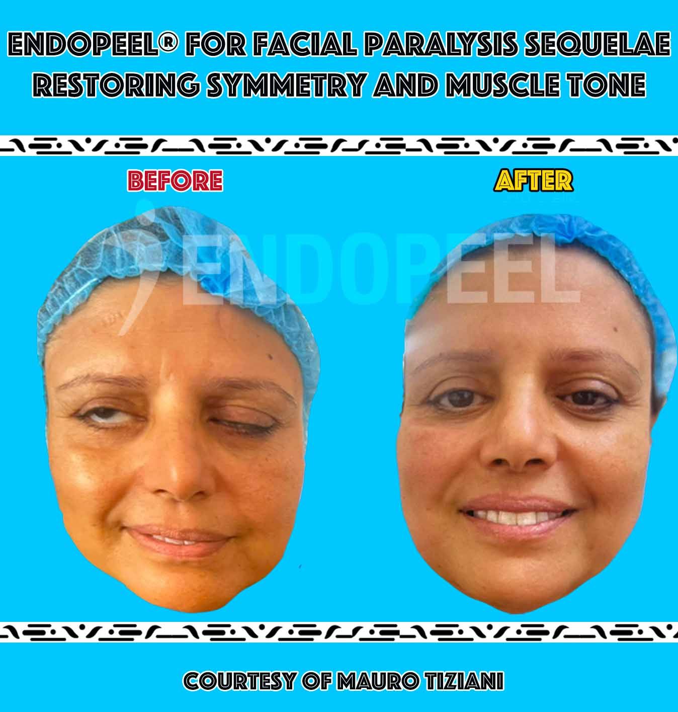 facial-paralysis